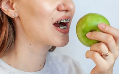 Qué se puede comer con brackets: alimentación e higiene en ortodoncia